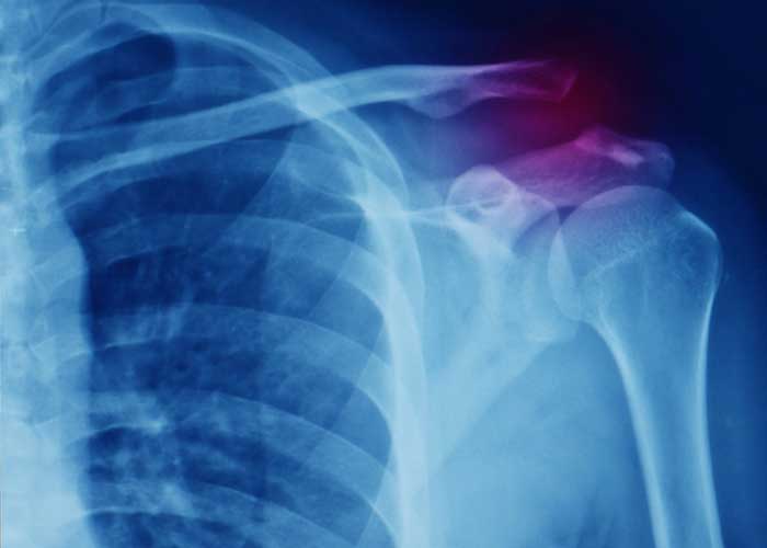 AC Joint injury, Shoulder Specialist