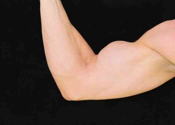 Biceps Tenodesis | Vail CO