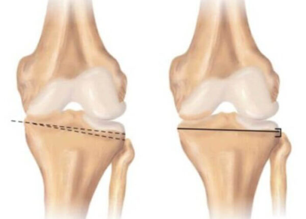 Knee Osteotomy | Vail CO