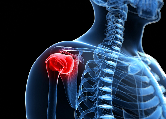 Reverse Shoulder Replacement | Vail CO