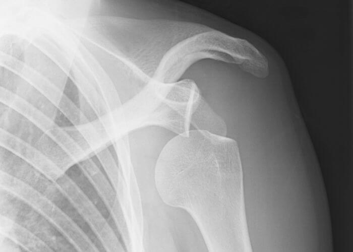 Shoulder Dislocation | Vail CO