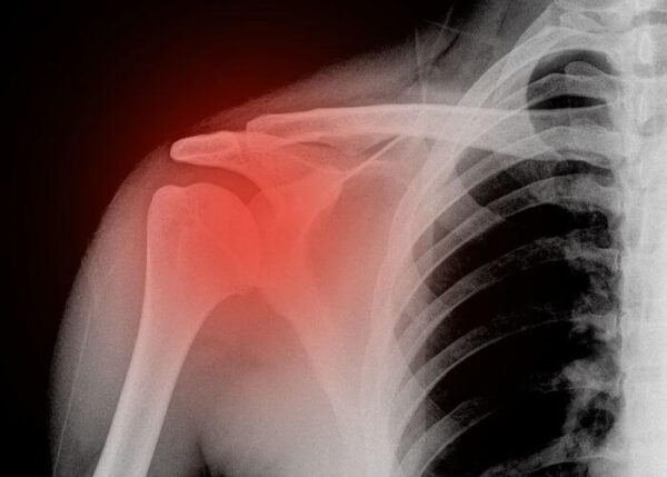 Shoulder Fracture | Vail CO