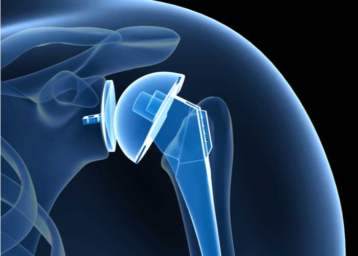 Shoulder Replacement | Vail CO