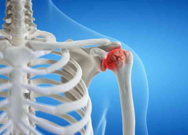 Shoulder Arthritis | Vail CO