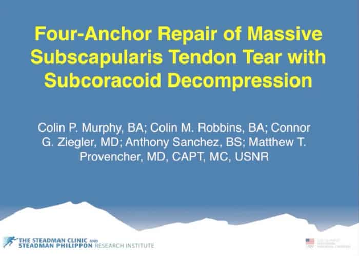 Four-Anchor Repair of Massive Subscapularis Tear with Subcoracoid  Decompression - Matthew Provencher, MD, Orthopedic Knee & Shoulder Surgeon