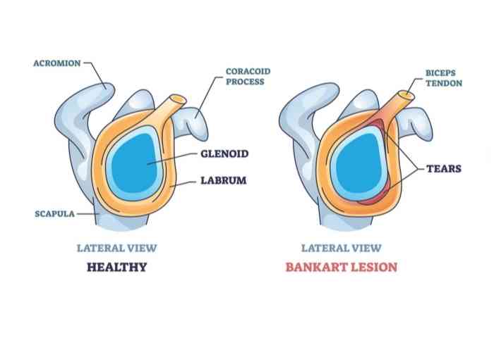 Bankart Lesion | Vail CO