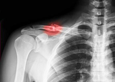 Clavicle Fracture | Vail CO