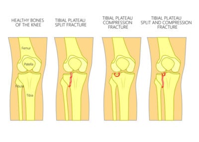 Tibial Plateau Fracture | Vail CO