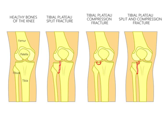 Chipped Tibia Bone Knee Fracture OrthoConnecticut